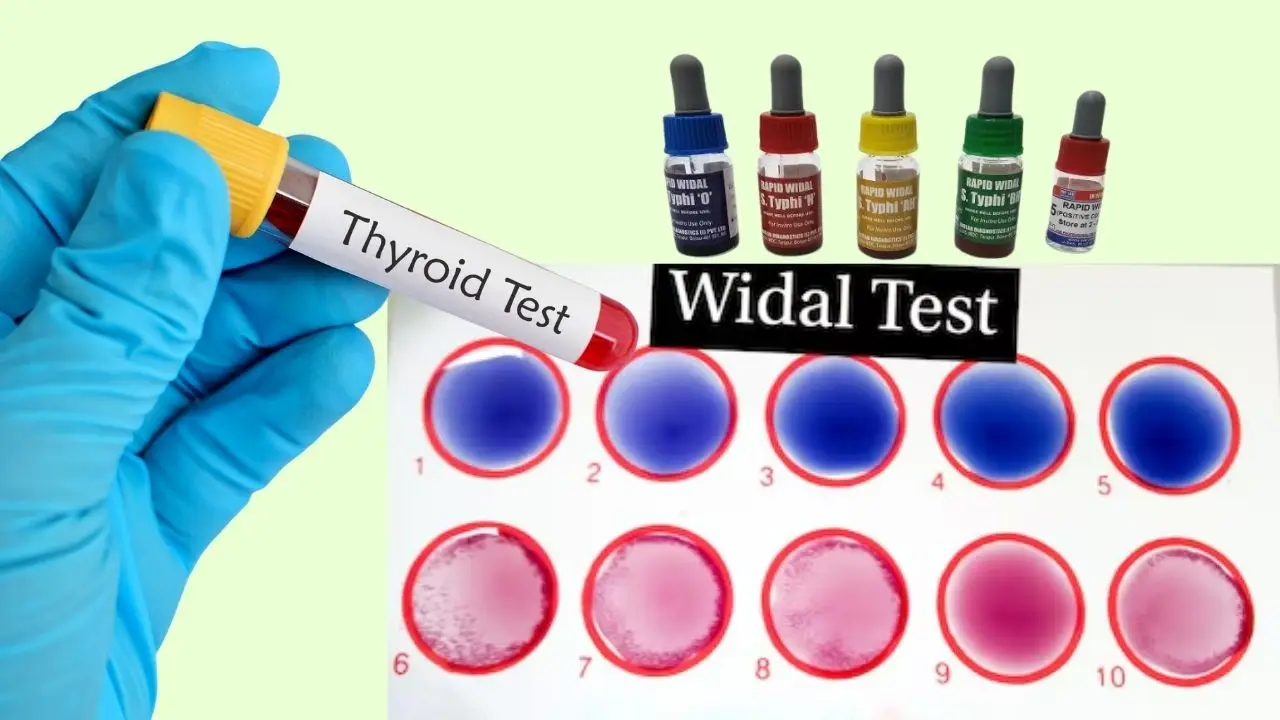 Laboratory Widal Test card showing positive and negative agglutination reactions for typhoid diagnosis