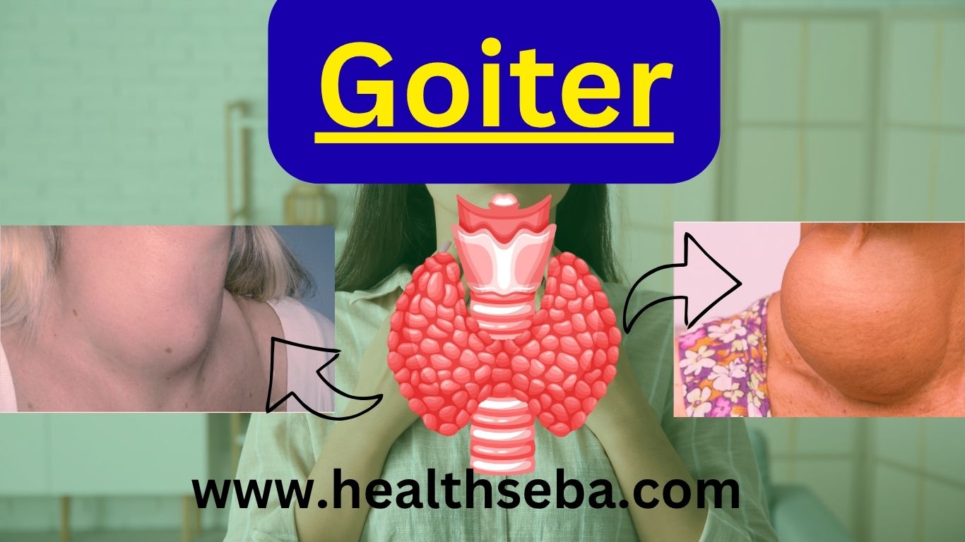 Goiter showing thyroid gland enlargement in the neck due to hormonal imbalance or iodine deficiency